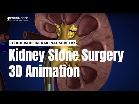 गुर्दे की पथरी (kidney stones) की सर्जरी (surgery) कैसे होती हैं?