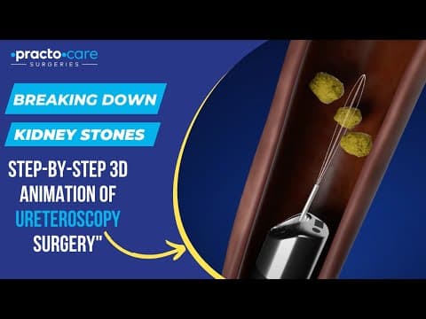 3D Animation: Ureteroscopy Surgery for Kidney Stones Explained