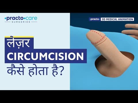 Laser Circumcision: A Step-by-Step Procedure (3D Animation) | Practo Care Surgeries